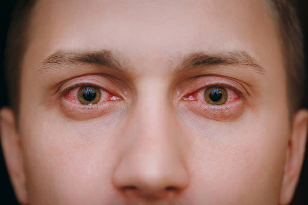COMMON EYE PROBLEM AFER 40 AC