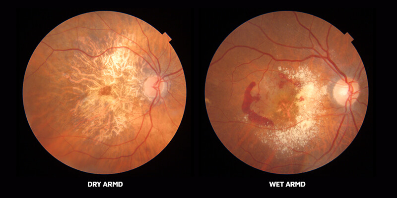 COMMON EYE PROBLEM AFER 40 ARMD