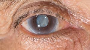 COMMON EYE PROBLEM AFER 40 CATARACT