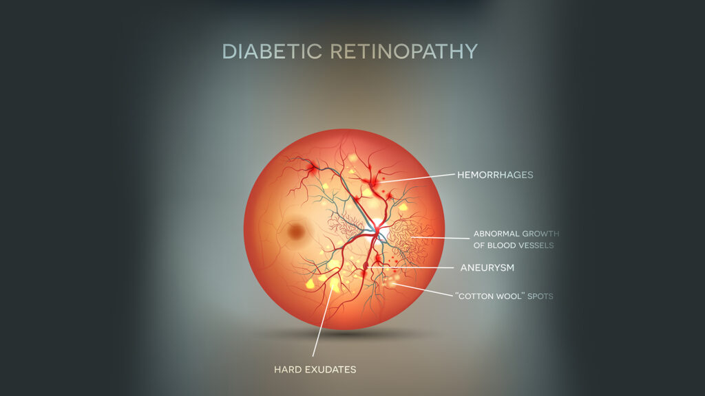 COMMON EYE PROBLEM AFER 40 DR