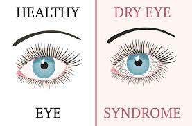 COMMON EYE PROBLEM AFER 40 DRY EYE
