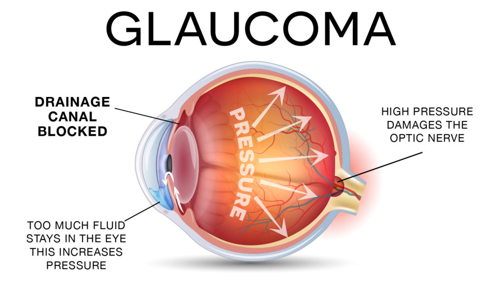 COMMON EYE PROBLEM AFER 40 GLAUCOMA