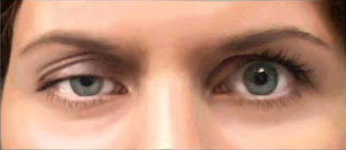 COMMON EYE PROBLEM AFER 40 PTOSIS