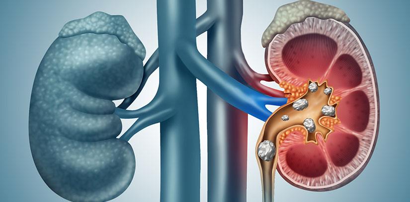 kidney stone