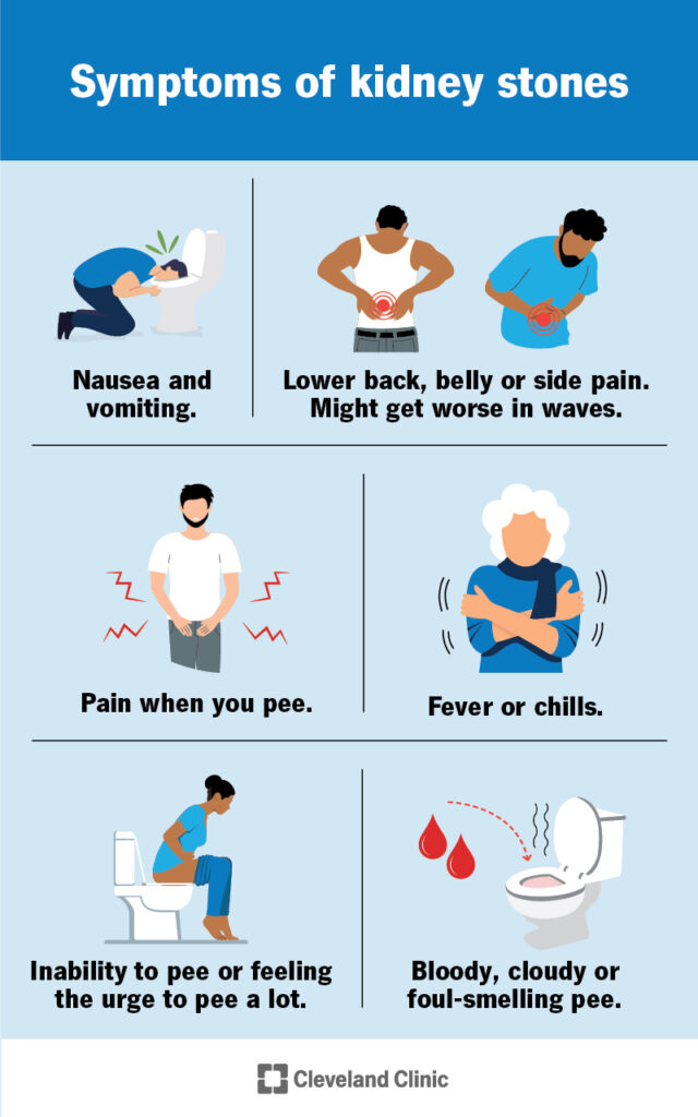 Kidney stones symptoms