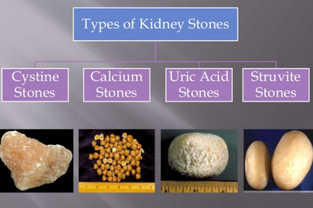 Kidney stones types