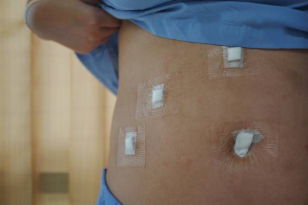 laparoscopic cholecystectomy ports
