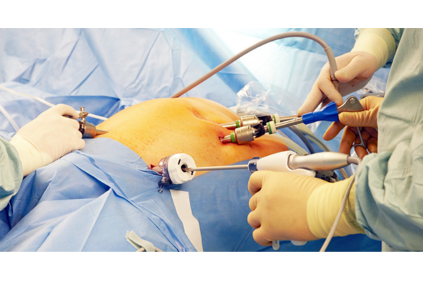 laparoscopic cholecystectomy